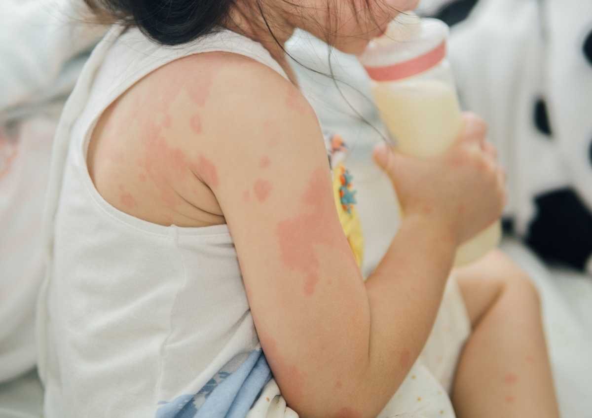 Bebeklerde Süt Alerjisi Nasıl Anlaşılır