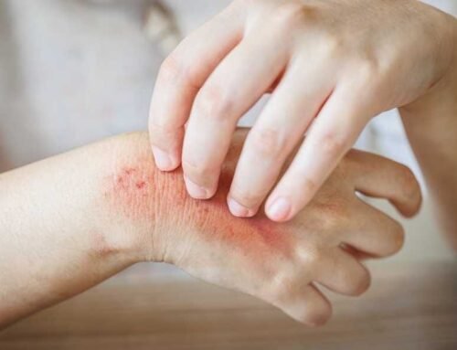 Soyuq hava və quru dəridə qaşıntını necə azaltmaq olar?