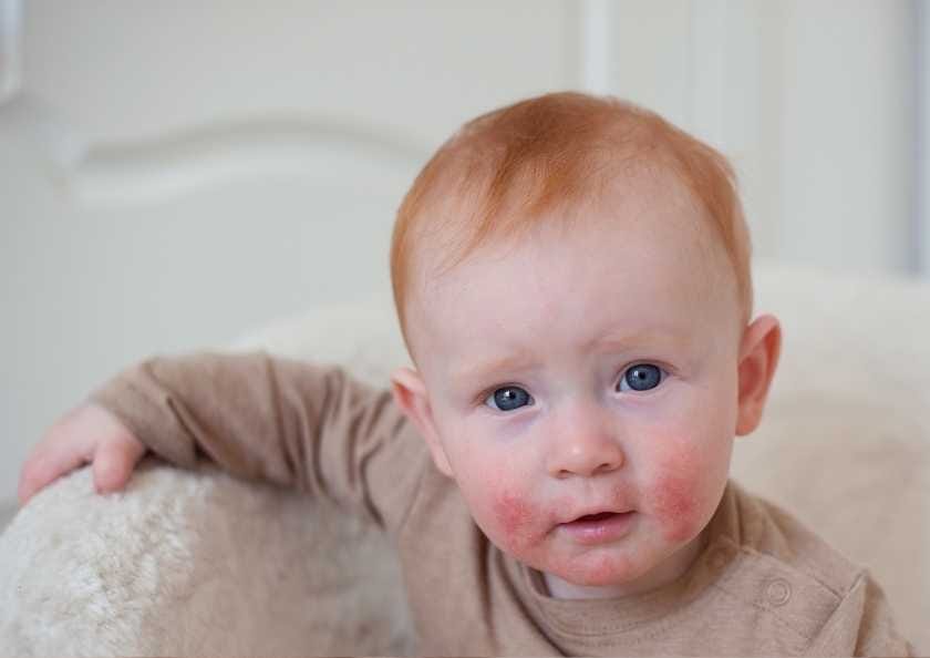 Uşaqlarda ekzema üçün ən uyğun qulluq üsulları