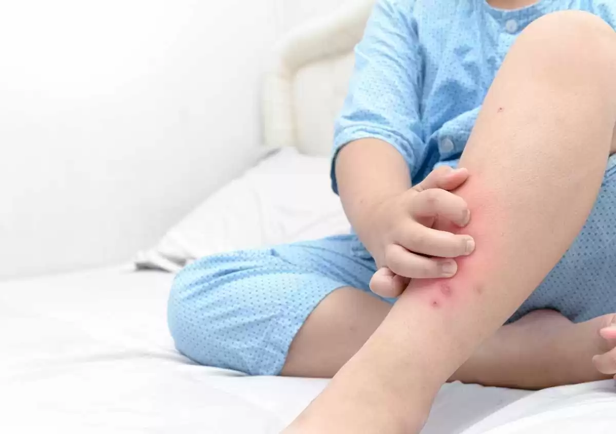 Sivrisinek Alerjisi Nedir Belirtileri Nelerdir