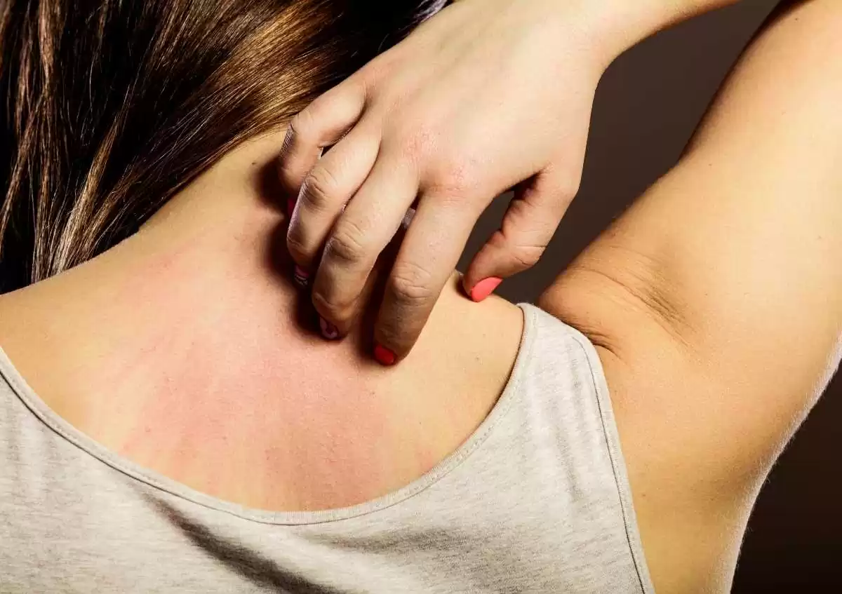 Yetişkinlerde Egzama (Atopik Dermatit) Belirtileri ve Tedavisi
