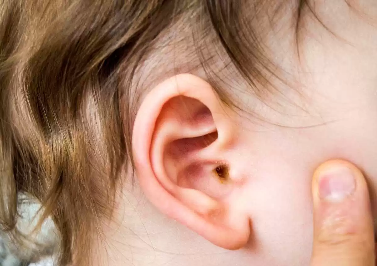 Bebeklerde ve Çocuklarda Orta Kulak İltihabı