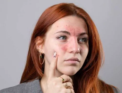 Ekzema və qida alerjisi arasında gizli əlaqələr varmı?