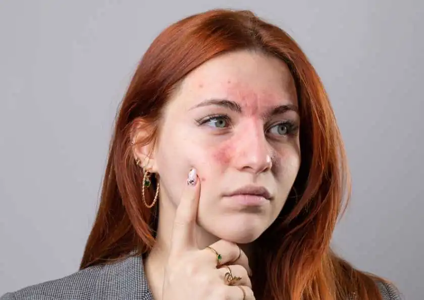 Ekzema və qida alerjisi arasında gizli əlaqələr varmı