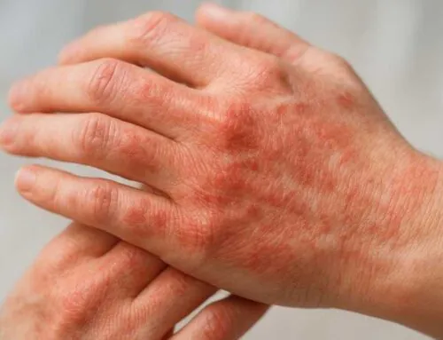 Kontakt dermatit: təmasla yaranan dəri reaksiyaları