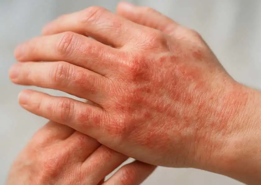 Kontakt dermatit təmasla yaranan dəri reaksiyaları